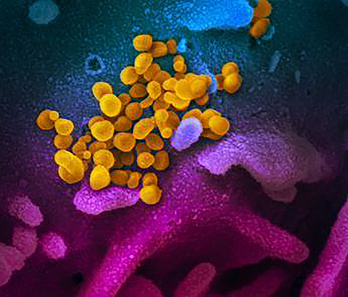 COVID-19 is the infectious disease caused by the coronavirus, SARS-CoV-2, which is a respiratory pathogen.: WHO first learned of this new virus from cases in Wuhan, People’s Republic of China on 31 December 2019.  This is a colorized scanning electron micrograph of an apoptotic cell (red) heavily infected with SARS-COV-2 virus particles (yellow), isolated from a patient sample. Image captured at the NIAID Integrated Research Facility (IRF) in Fort Detrick, Maryland. NIAID National Institute of Allergy and Infectious Diseases (NIAID)
